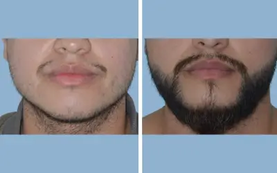 Before and After